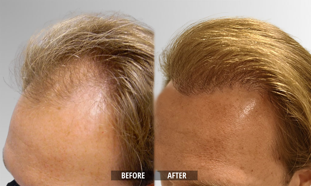 Lustré Hair growth serum
